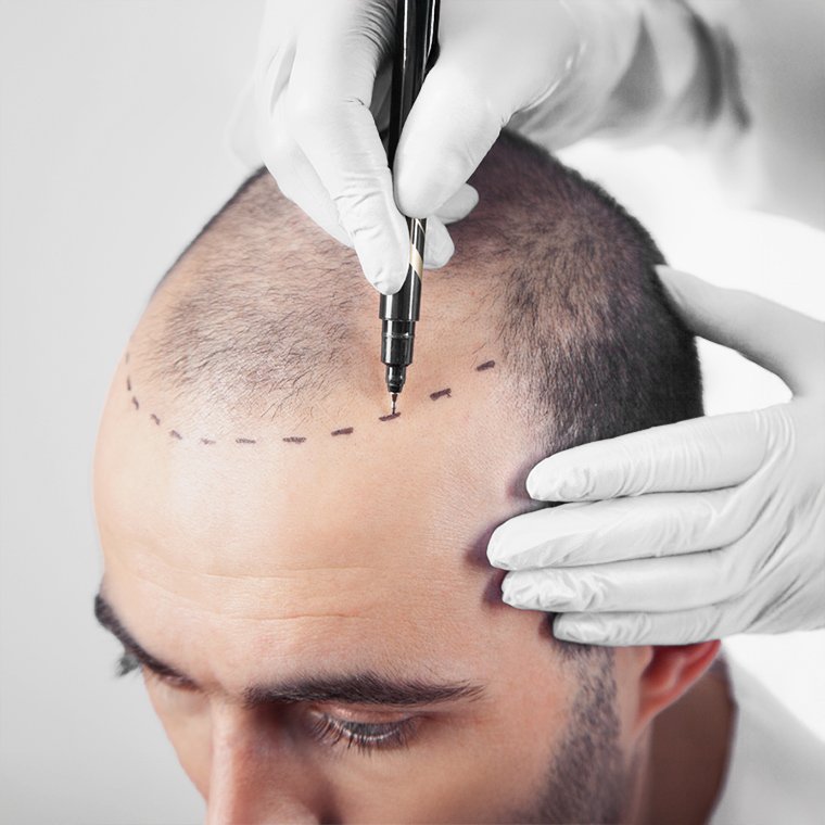  <span class="lte-header lte-h6"> Comprehensive Hair Loss Diagnosis and Treatment </span> 